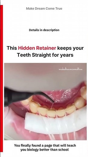 🦷 This Hidden Retainer keeps 🪡 your Teeth Straight for Years 🧑‍⚕️ | MDCT