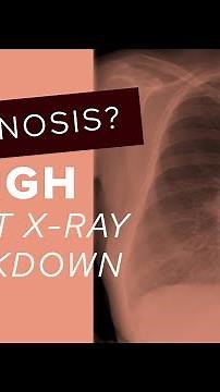 Chest X-Ray guide: how to assess the hilar regions