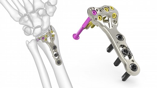 Acu-Loc 2 Wrist Plating System