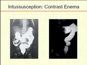 Intussusception