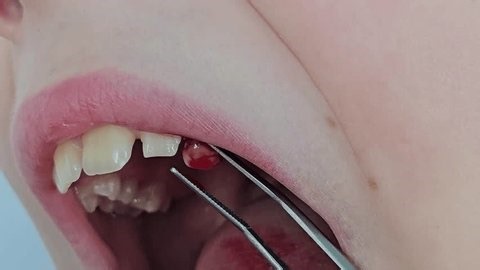 Dentist Removes Tooth Childs Mouth During Stock Footage Video (100% Royalty-free) 4025727487 | Shutterstock