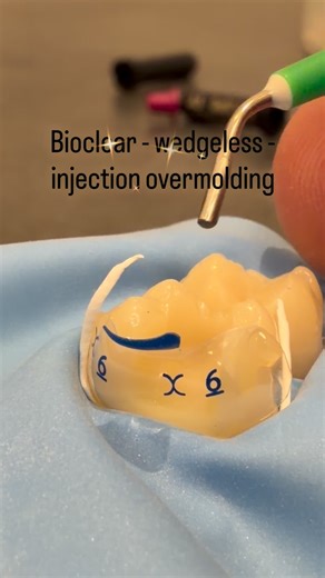 Malte Heinrich | Doing some model work today #Bioclear #directcomposite #bioclearwedgeless | Instagram