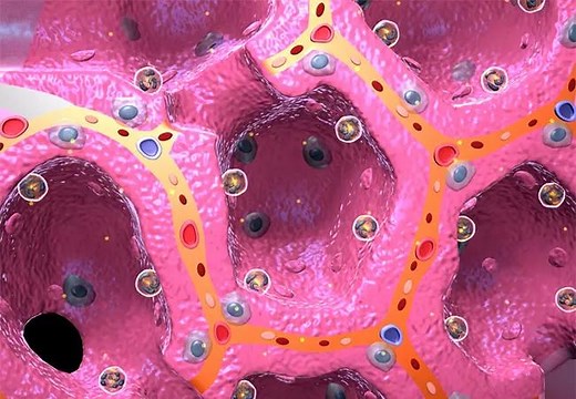 Progression to ARDS in COVID-19: Here’s What It Looks Like