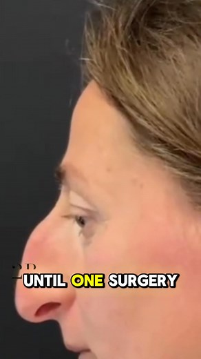 She was always shy about her looks… until one surgery changed everything. 💔➡️💖 When the bandages came off, no one could believe their eyes — she looked stunning! 😱✨ Watch the full transformation in the comments below 👇👇👇 #Transformation #UnbelievableChange #MustWatch | Before and After