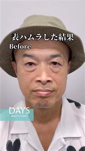 [Dark circles removal] Miraculous rejuvenation #shorts