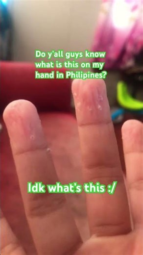 Did that happened to ur hands? In Philipines?