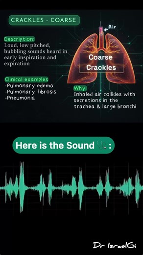 Coarse Crackles Lung Sound: Identification & Causes | Medical Quiz