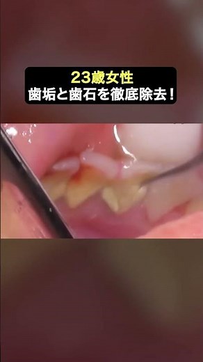 【歯石除去】見違えるように綺麗になったビフォーアフター必見です👀✨#ザホワイトデンタルクリニック #歯医者 #歯石除去