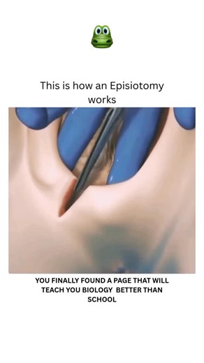 BIOLOGY | MEDICAL | HEALTH on Instagram: "An episiotomy is a surgical cut made in the perineum (the area between the vagina and anus) during vaginal delivery to widen the vaginal opening and facilitate delivery of the baby. There are two main types: median (a straight cut toward the anus, which can be extended and is easier to suture) and mediolateral (an angled cut, which has a lower risk of tearing but may take longer to heal). It is sutured after birth, and although it can prevent serious tea