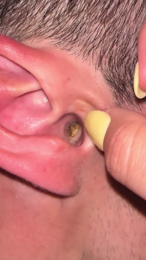 Effective Earwax Removal Kit Review | Try It Now!