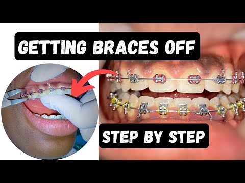 She Finally Got Her BRACES OFF! - What happens next | Braces Off step by step