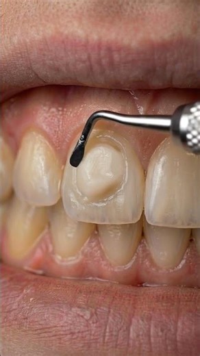Tooth Decay Cleaning – Instant Result 😱 #dentist #satisfying #shorts
