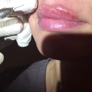 Lip Augmentation with Juvederm