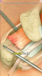 Rotator Cuff Repairs (3D Animation)#rotatorcuff #repair #surgery #pain #3danimation