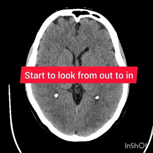 CT Brain #radiology made easy