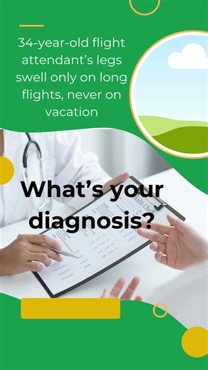 34 year old flight attendant’s legs swell only on long flights, never on vacation