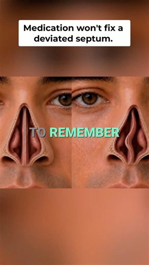 Deviated Septum: Why Nasal Sprays May Not Work