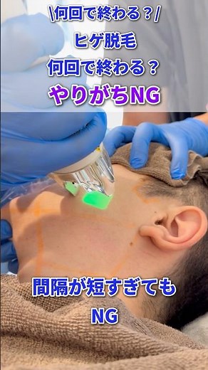ヒゲ脱毛って何回必要？ #shorts