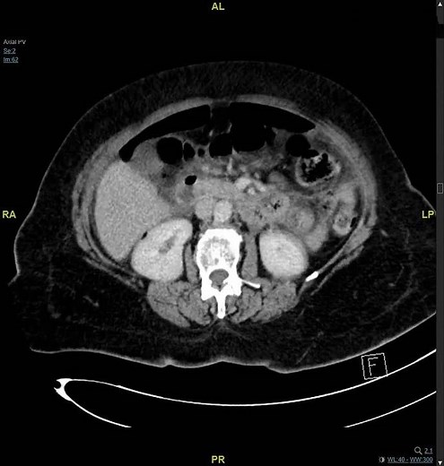 Abdominal CT scan showing perforated duodenum with pneumoperitoneum and free fluid.