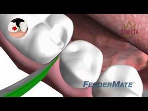 How to Use - Directa FenderWedge & FenderMate