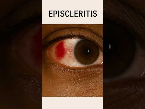 Red Eye Explained: How to Tell Conjunctivitis, Uveitis, or Scleritis Apart | Eye Learn Academy