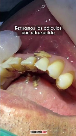 Remoción de Cálculos Dentales #SarroDental - Odontologia Láser #Shorts