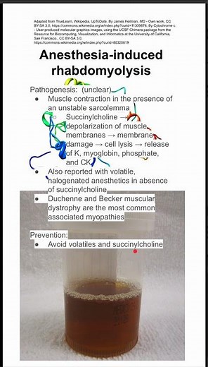 Anesthesia-induced rhabdomyolysis