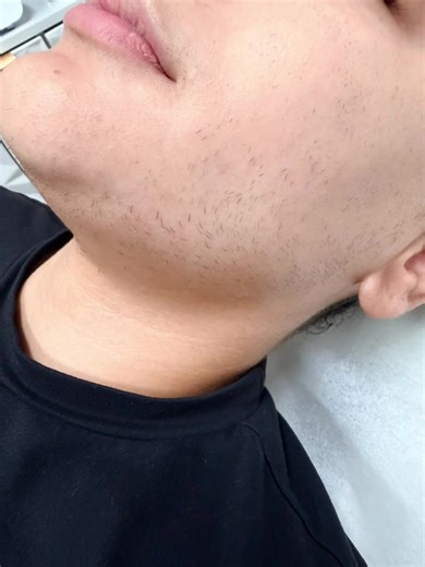 Did you know laser hair removal can sometimes cause more hair growth? It’s called paradoxical hypertrichosis — a side effect where hair becomes thicker, darker, or spreads to surrounding areas instead of permanently going away. This is most commonly seen on hormone-sensitive areas like the face, chin, and neck, especially in clients with conditions like PCOS. While laser can reduce hair for some people, it doesn’t destroy every follicle permanently. Electrolysis does. ✨ Electrolysis is the only 