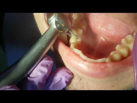 TEETH FILLING - BEFORE AND AFTER !!