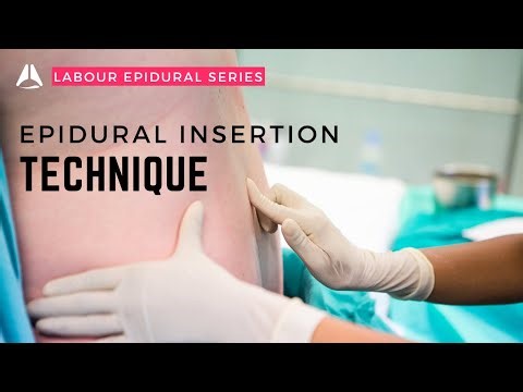 The Epidural Insertion | #anesthesiology #anesthesia #analgesia #epidural