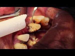 Dental Tartar (Calculus) Removal