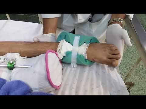 Teste de clonus lesão de primeiro neurônio snc