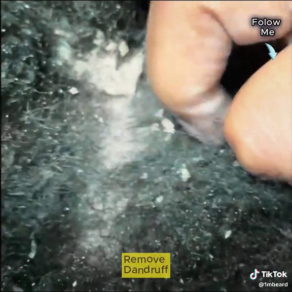 Dandruff is so bad it's annoying #dandruff #fyp #dandruffremovel #dandruffproblem #asrm #hair #removedandruff