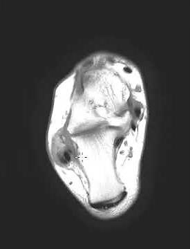 Peroneus brevis tendon split tear in 49 year old