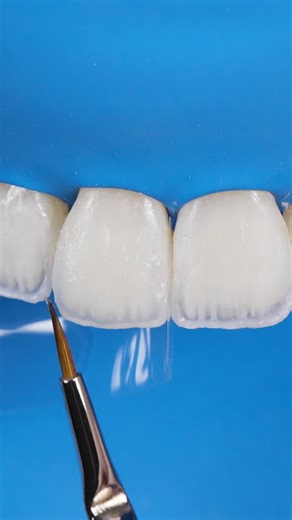 Alan Vieira Costa | Micro layering process with composite resin On this case, a flowable opalescent resin to increase the internal anatomical details. | Instagram