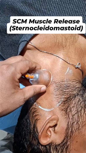 DrVikas Pandey on Instagram: "SCM Muscle Release (Sternocleidomastoid Muscle Release) SCM muscle neck ke dono side hoti hai—ear (mastoid process) se sternum aur clavicle tak. Isme tightness ya trigger points hone se neck pain, headache, dizziness, facial pain, ear pain jaise symptoms aa sakte hain NEURO SPINE PHYSIOTHERAPY AND DENTAL CLINIC Chandmari Market Near Ringroad Varanasi Contact Us 9559700343 #Cervical #neckpain #spinecare #physiotherapy #musclepain"