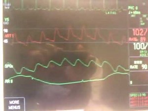 Pulse Pressure Variation