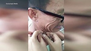 Revolting footage of a 20-year-old blackhead