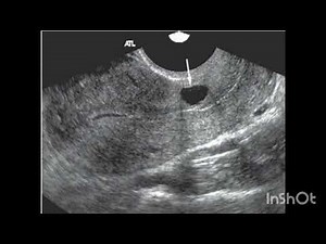 Ultrasound of Nabothian Cysts: What You Need to Know