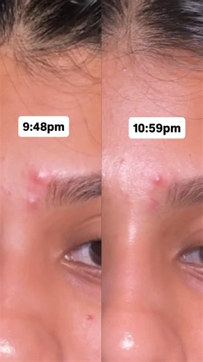 Vishali Jaikumar on Instagram: "#notsponsored Comment for “links” ✨ . . Product- @theordinary Sulfur 10% powder to cream concentrate . . Thanks @tandemcommunication for sending me this product 🫶🏻 . . #nonsponsored #review #skincare #reels [Acne, Inflammed skin, Blemish control, Acne Reduction, Ordinary Sulfur 10%, Powder to cream, Chennai blogger, Skincare , Acne care]"