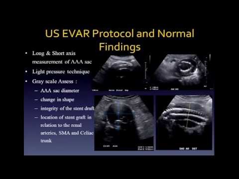 Complications of Endovascular Stent Graft Repair