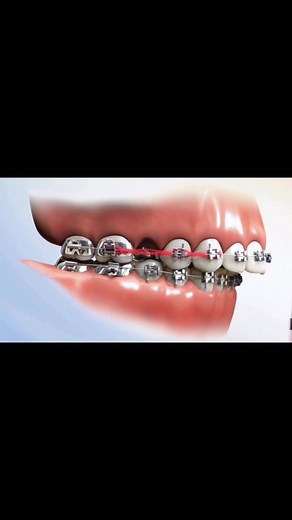 Braces treatment…..extraction gap close…power chain .. over jet bite…...#creatorsearchinsights #drtariq#dentistry_everyday🦷🤍 #orthodontics #braces #bracestips #dentist #fyp #trending #tiktokviral