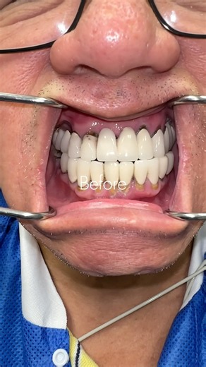 What do you think of this transformation? #smilemakeover #allonx #allon4
