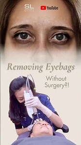 Eyebag Removal without Surgery #doctor #eyebags #tired #eyes #undereyedarkcircles #undereyecircles