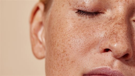 Freckle or melanoma? How to tell the difference.
