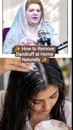 How to Remove Dandruff at Home Naturally✨#hair#beauty# #homeremedies#fyp #haircareroutine #hair#diy