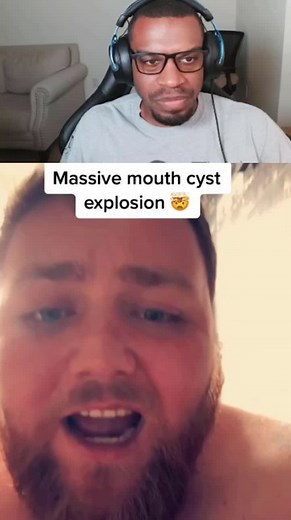 IT JUST POPPED IN HIS MOUTH!!! #pimple #pimples #cyst #cystpopping #reaction