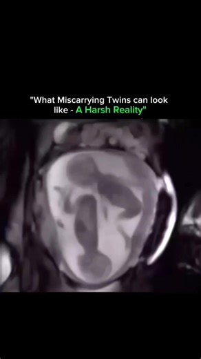 SCIENCE | HISTORY | FACTS | EXPERIMENT on Instagram: "Pregnancy with twins is often seen as joyful and rare — but medically, it also comes with higher risks, including miscarriage. Understanding the science behind it helps replace shock with compassion. 1️⃣ Vanishing Twin Syndrome: In many early pregnancies, one embryo may stop developing and is reabsorbed into the mother’s body or the surviving twin. This can happen silently with no symptoms at all. 2️⃣ Placentation Issues: Twins share space, b
