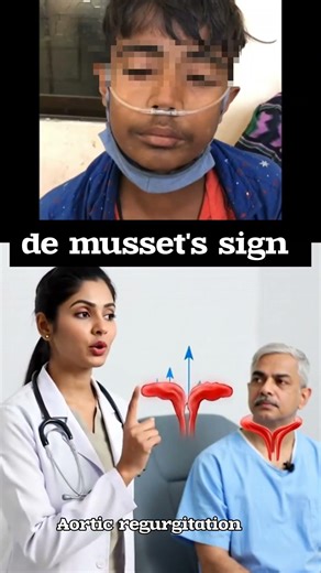 de Musset's sign of aortic regurgitation #chestpain #heart #headache #aorticvalve #aorta #mussetsign