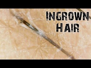 Hair Ingrown | Satisfying Hair Extraction